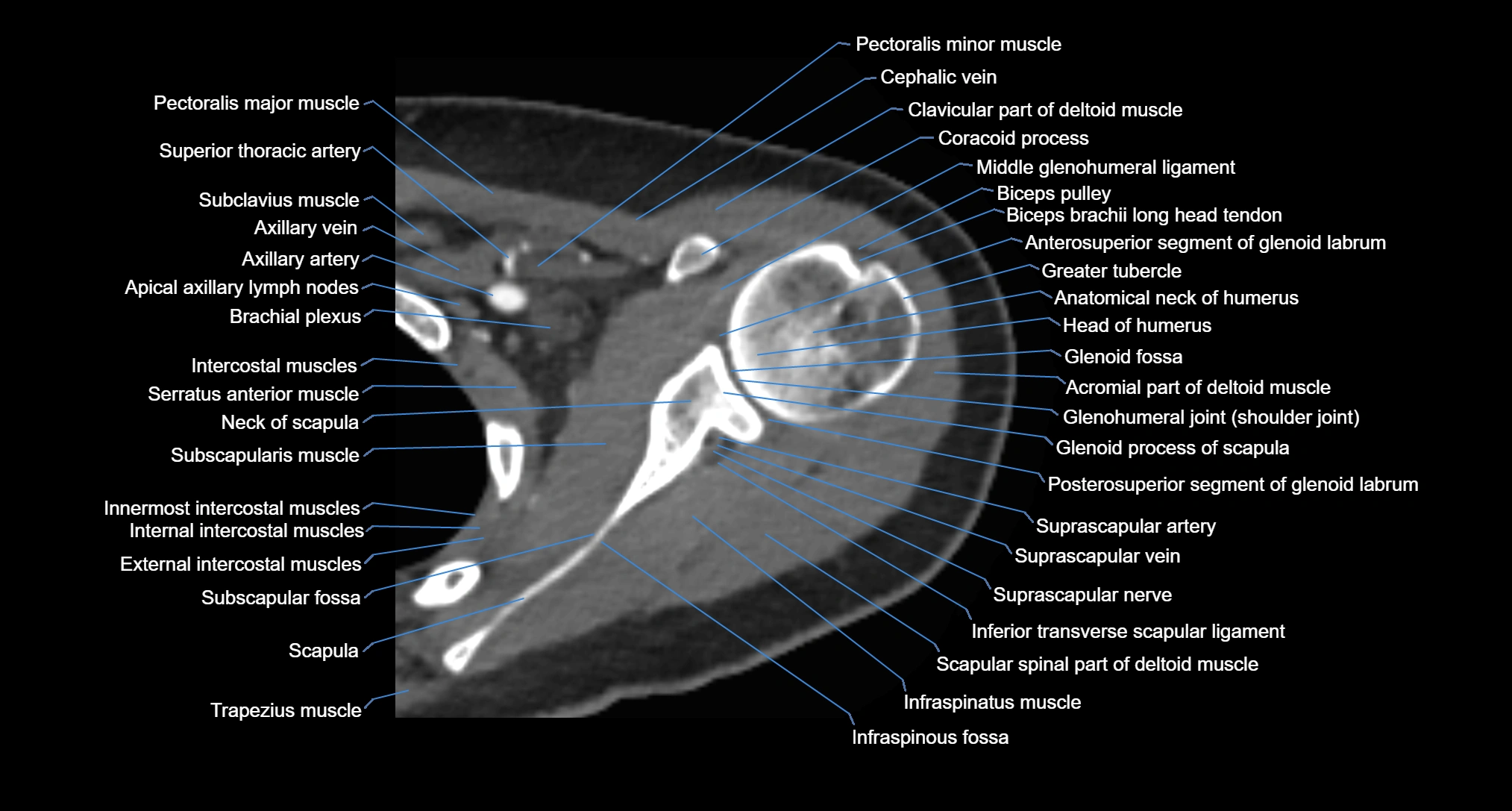 CT Shoulder axial cross sectional anatomy labelled radiology image -00030.webp